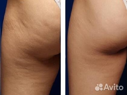 Вакуумно-роликовый массаж/выезд на дом