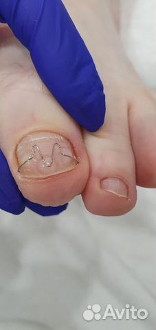 Аппаратный педикюр