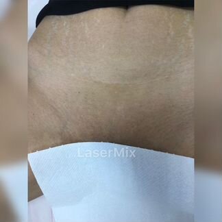 Аппарат для лазерной эпиляции